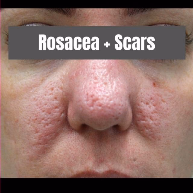 How does TCA treatment work?